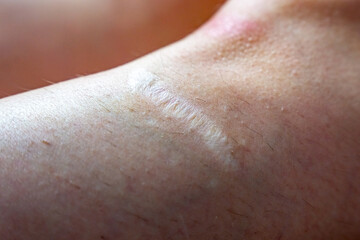 Naklejka premium Big scar on a hairy leg