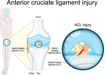 Anterior cruciate ligament injury. Close-up of a human knee joint