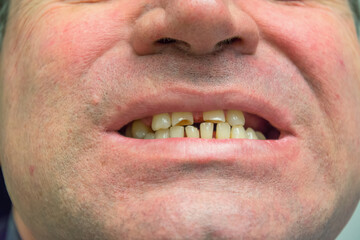 A close-up shot of the mouth of a male patient who sits at a dentist's appointment and shows his damaged teeth BEFORE prosthetics. The man is missing some teeth and has very worn teeth.