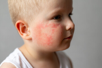 Small child with red rash on cheek