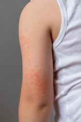 Child's arm with red rash