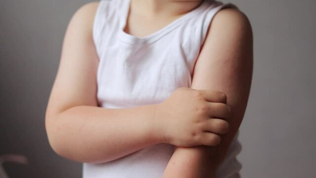 Child scratching arm with red rash