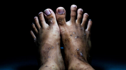 Close-up of feet with severe ulceration and dry wounds. Ideal for medical literature, healthcare...