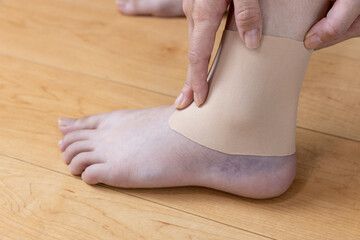 捻挫した女性の左足首に湿布を貼っている