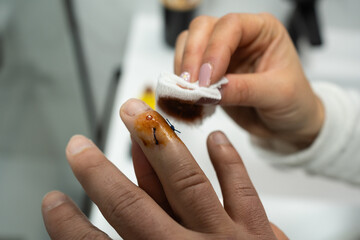 Close-up of anonymous woman tenderly tending to post-surgery finger with povidone iodine soaked...