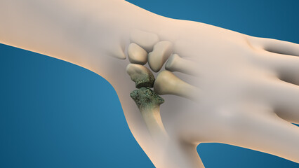 Arthritis of the finger and thumb joint