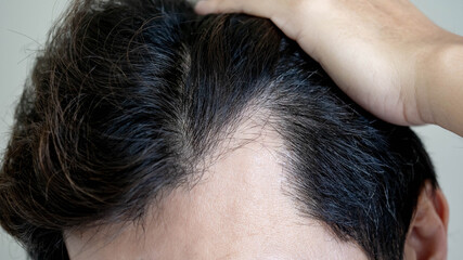 Hair loss or alopecia problem. Receding hairline. Closeup head of Asian man while raising up his black damaged hair showing bald head area.