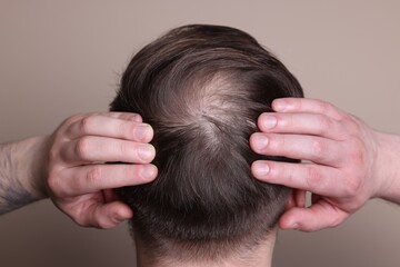 Fototapeta premium Baldness concept. Man with bald spot on beige background, back view