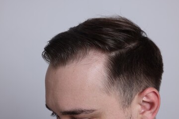 Obraz premium Baldness concept. Man with receding hairline on light grey background, closeup