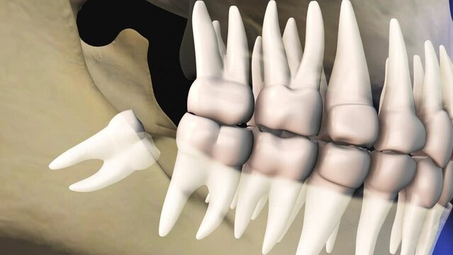 Concept of wisdom teeth pain