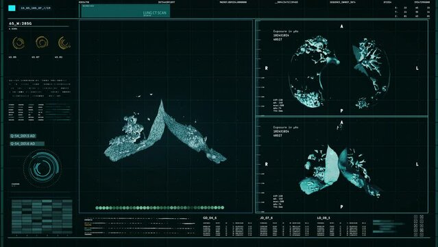 Futuristic organ diagnosis system is analyzing the projection of human lungs. Futuristic organ diagnosis tech is scanning through the lungs. Futuristic organ diagnosis has detected Lung Cancer Cells.