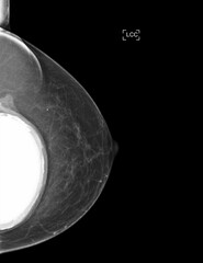 The mammogram BI-RADS 2-benign shows a breast implant augmentation with visible signs of capsular...