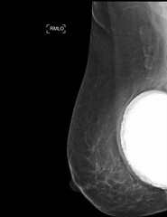 The mammogram BI-RADS 2-benign shows a breast implant augmentation with visible signs of capsular...