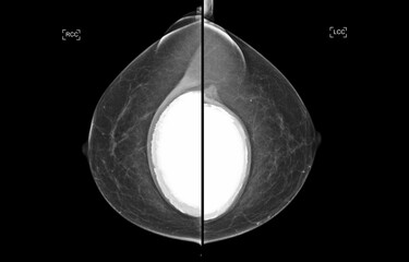 The mammogram BI-RADS 2-benign shows a breast implant augmentation with visible signs of capsular...