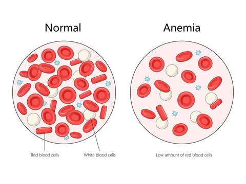 normal blood cells with anemic blood cells, highlighting the low amount of red blood cells in anemia diagram hand drawn schematic raster illustration. Medical science educational illustration