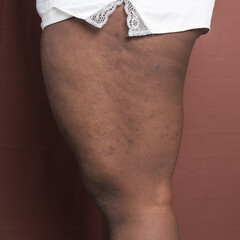 Eczema on brown skin, brown skin with hyperpigmentation and scarring from eczema and atopic...