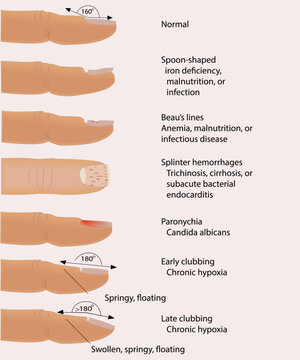 Medical illustration. Nail disease.informational poster for podiatrists. Nail diseases. Medicine and cosmetology. Vector illustration