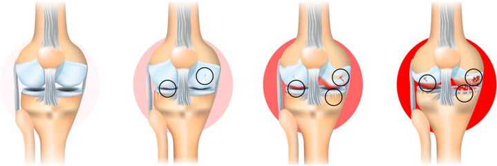 Stages of knee joint osteoarthritis
