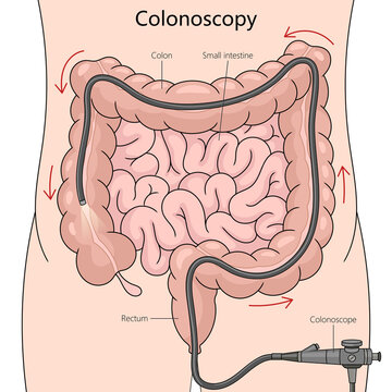 colonoscopy procedure, detailing the path of the colonoscope through the colon and small intestine diagram hand drawn schematic raster illustration. Medical science educational illustration