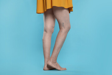 Closeup view of woman with varicose veins on light blue background