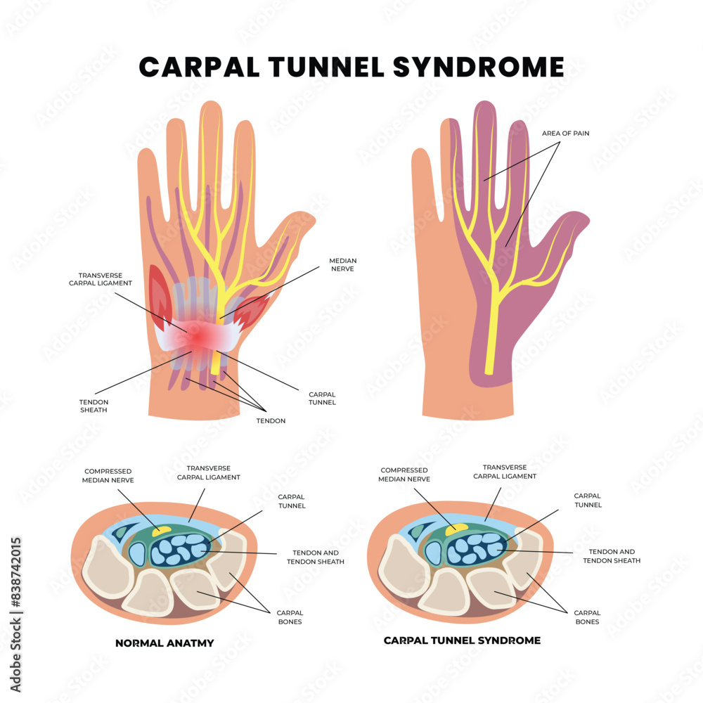 Wall mural carpal tunnel syndrome diagram poster infographic banner, diagram closeup with muscle, transverse ca