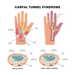 Carpal Tunnel Syndrome diagram poster infographic banner, diagram closeup with muscle, transverse carpal ligament, median nerve, tendon sheath, flexor tendons and bones, Carpal tunnel scheme.