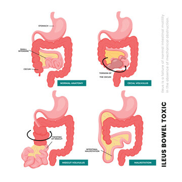 Set of different types of ileus bowel toxic poster scheme, with normal anatomy, cecal volvulus, midgut volvulus, malrotation, Irritable bowel syndrome, constipation, intestinal obstruction.