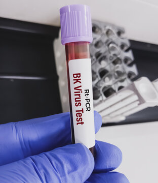 Blood sample for Real time PCR BK virus test.