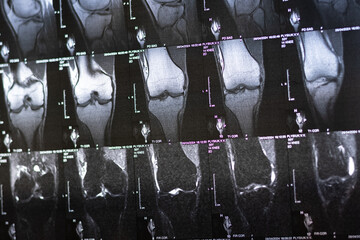 Bone knee tumor. X-ray and MRI, MRT, CT with marked sclerosis around the nidus. Medical treatment...