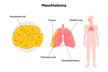 Mesothelioma disease, lung problems, healthy lungs