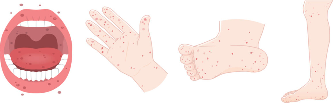 舌、歯、手、足、手足口病のイラスト、HFMD、llustration