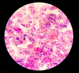 Atypical squamous cells of undetermined significance, it may be a sign of infection with certain types of human papillomavirus (HPV) or other types of infection, such as a yeast infection.