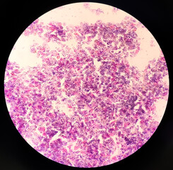 Atypical squamous cells of undetermined significance, it may be a sign of infection with certain types of human papillomavirus (HPV) or other types of infection, such as a yeast infection.