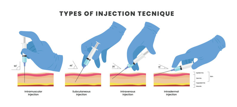 Different types of injection technique poster or medical banner scheme, with Various methods of needle jab in skin. Intramuscular, subcutaneous, intravenous and intradermal process