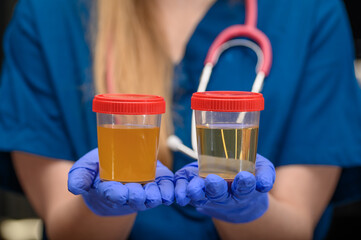 Pani doktor trzyma w dłoniach pojemniki na mocz wypełnione cieczą, klarowny słomkowy i ciemny nieprzejrzysty mocz