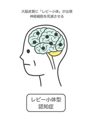 レビー小体型認知症によって損傷を受ける脳の部分とその名称のイラスト