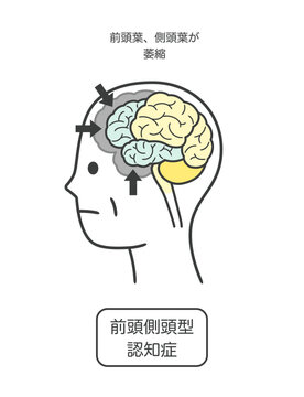前頭側頭型認知症によって損傷を受ける脳の部分とその名称のイラスト