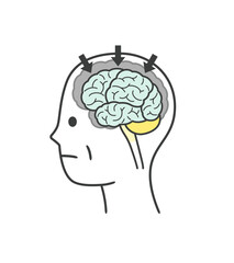 アルツハイマー型認知症によって損傷を受ける脳の部分のイラストのセット
