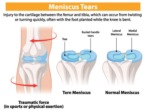 Illustration of normal and torn meniscus in knees