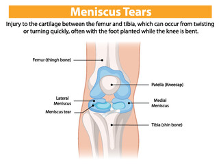 Illustration of knee meniscus tear anatomy