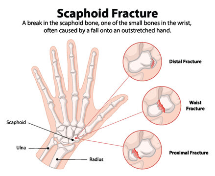 Detailed diagram of scaphoid bone fractures