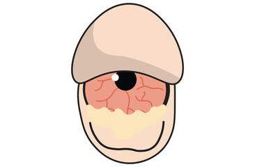 Obraz premium Mucous membrane pemphigoid,Cicatricial,chronic autoimmune causing blistering and scarring of the mucous membranes, including the eyes,Stevens-Johnson syndrom,ocular,Mooren's ulcer,vectors
