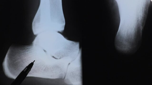 Doctor examining X-ray scan of Calcaneus or heel bone destruction. Bone of the tarsus of the foot. Medical treatment concept. Diagnosis of the disease humans bones.