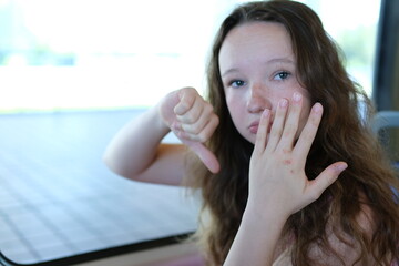 A young girl sadly shows her hand with warts. Many viral warts on the hand. Viral wart, verruca, is a skin disease caused by the HPV variant of the human papillomavirus.