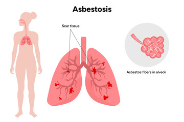 Asbestos-related diseases