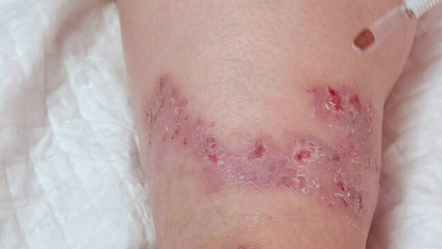 doctor, nurse heals wound on female leg with medicine, medical concept, venous ulcers, diabetes mellitus, healing ulcers, eliminating inflammatory process, sanitation pathogenic microflora