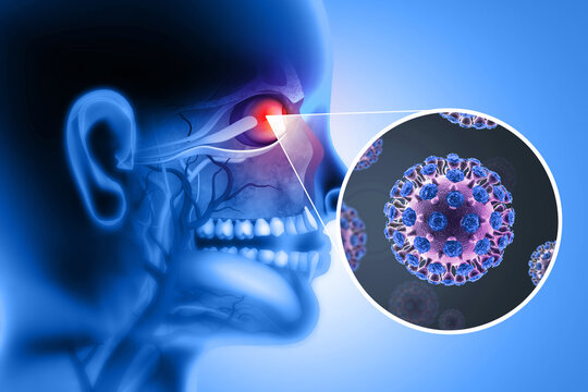 Conjunctivitis Eye Infection. 3d illustration