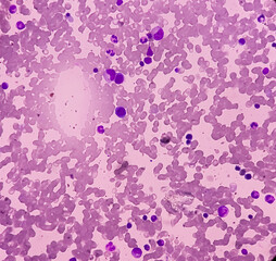 Bone marrow study (BMD). Amegakariocytic thrombocytopenia with dimorphic erythroid hyperplasia....