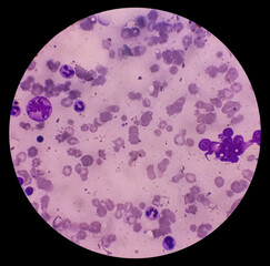 Bone marrow study (BMD). Amegakariocytic thrombocytopenia with dimorphic erythroid hyperplasia....