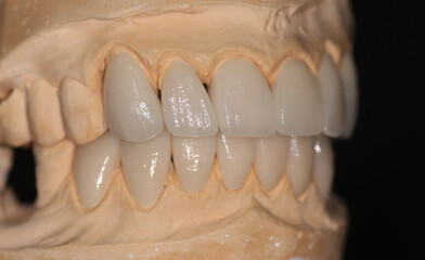 Dental veneersin the plaster model for the dentist to fix to the patient